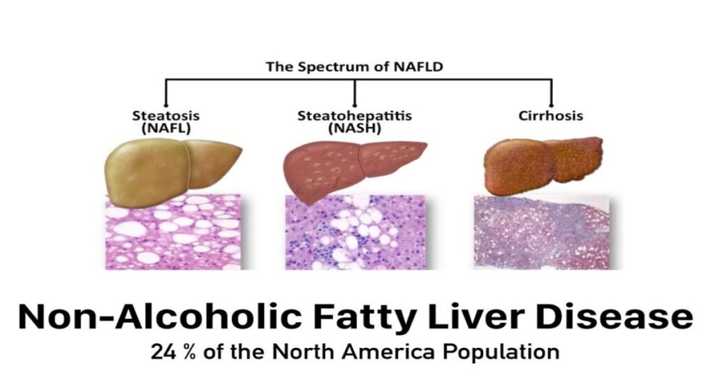 A diagram showing types of non alcoholic fatty liver disease