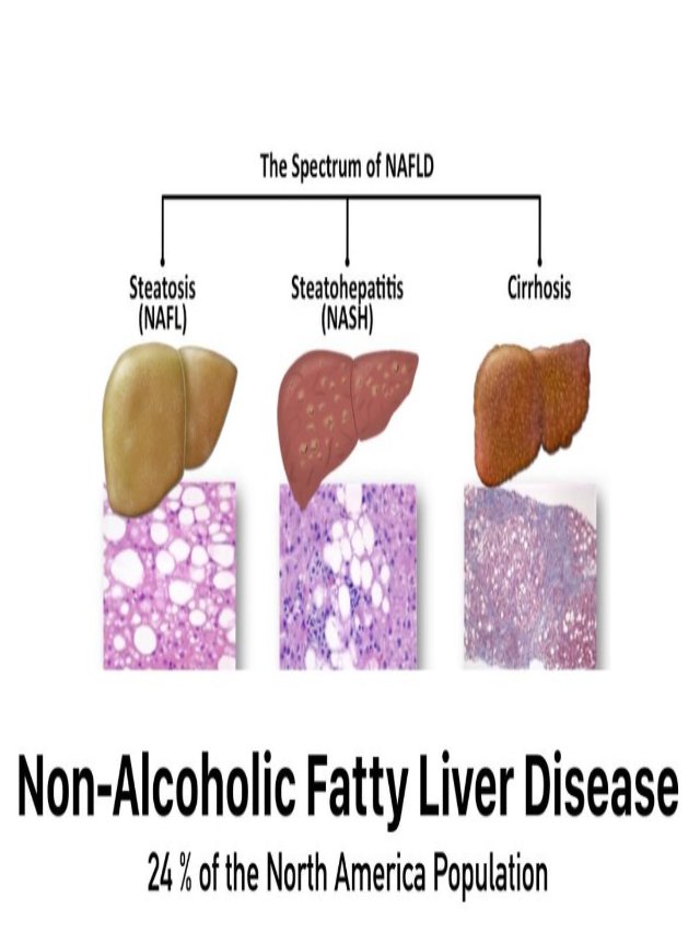 nonalcoholic fatty liver disease. Its symptoms and causes.