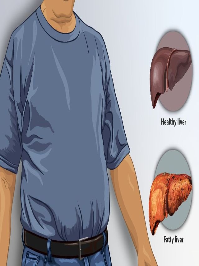 What is fatty liver disease (FLD)