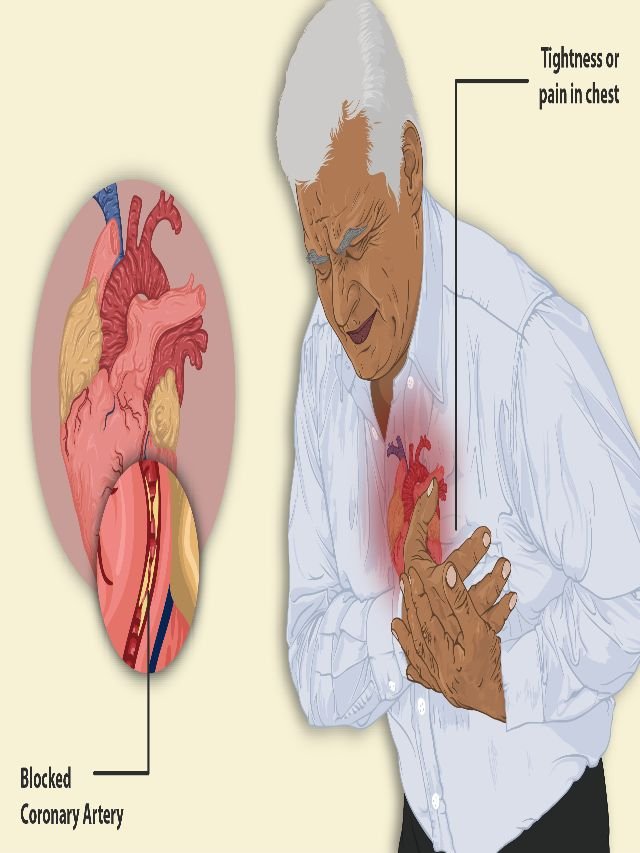 Immediate Steps You Must Take after having a Heart Attack