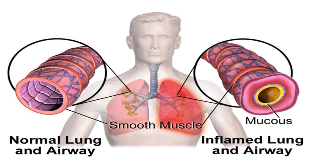 "A diagram showing normal lung's airway and imflammed lung's airway"