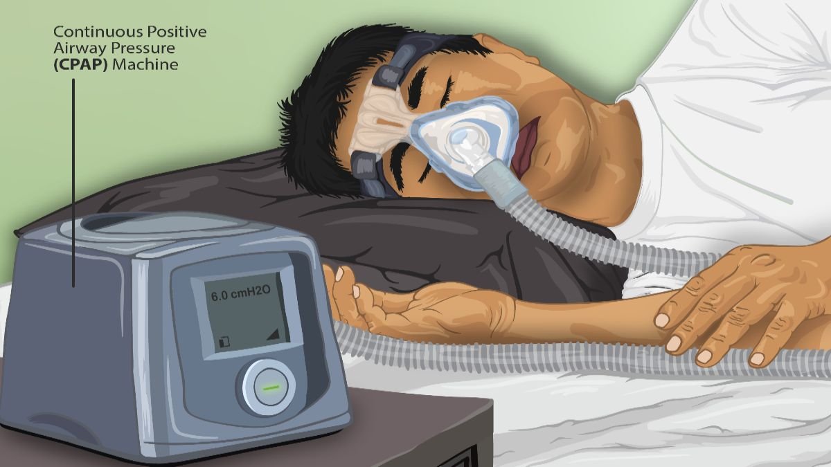 Sleep Apnea: Causes, Symptoms, Treatment, and Prevention