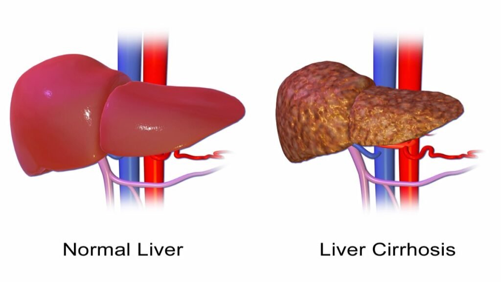 Cirrhosis: Symptoms, Causes, Treatment, and Prevention