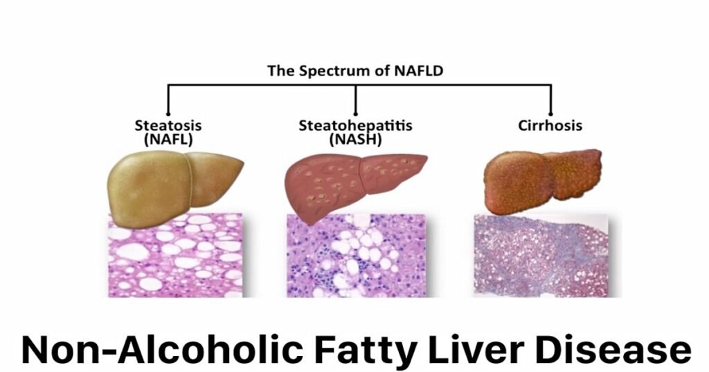 spectrum of non-alcoholic fatty liver disease.