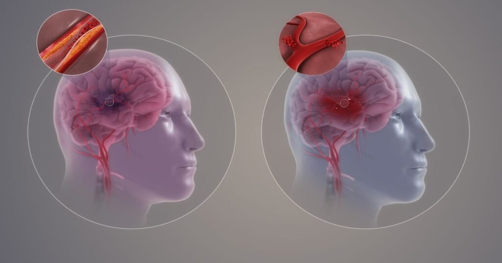 types of stroke