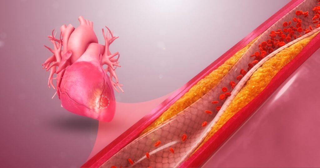 "Narrowing or blockage of the coronary arteries caused by the buildup of plaque."