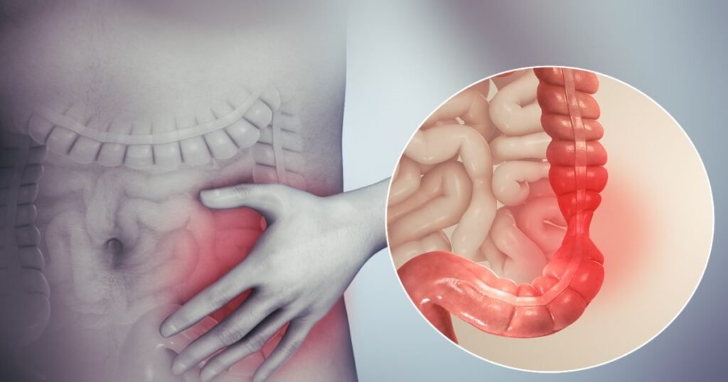 "An intestine showing Irritable Bowel Syndrome (IBS)"