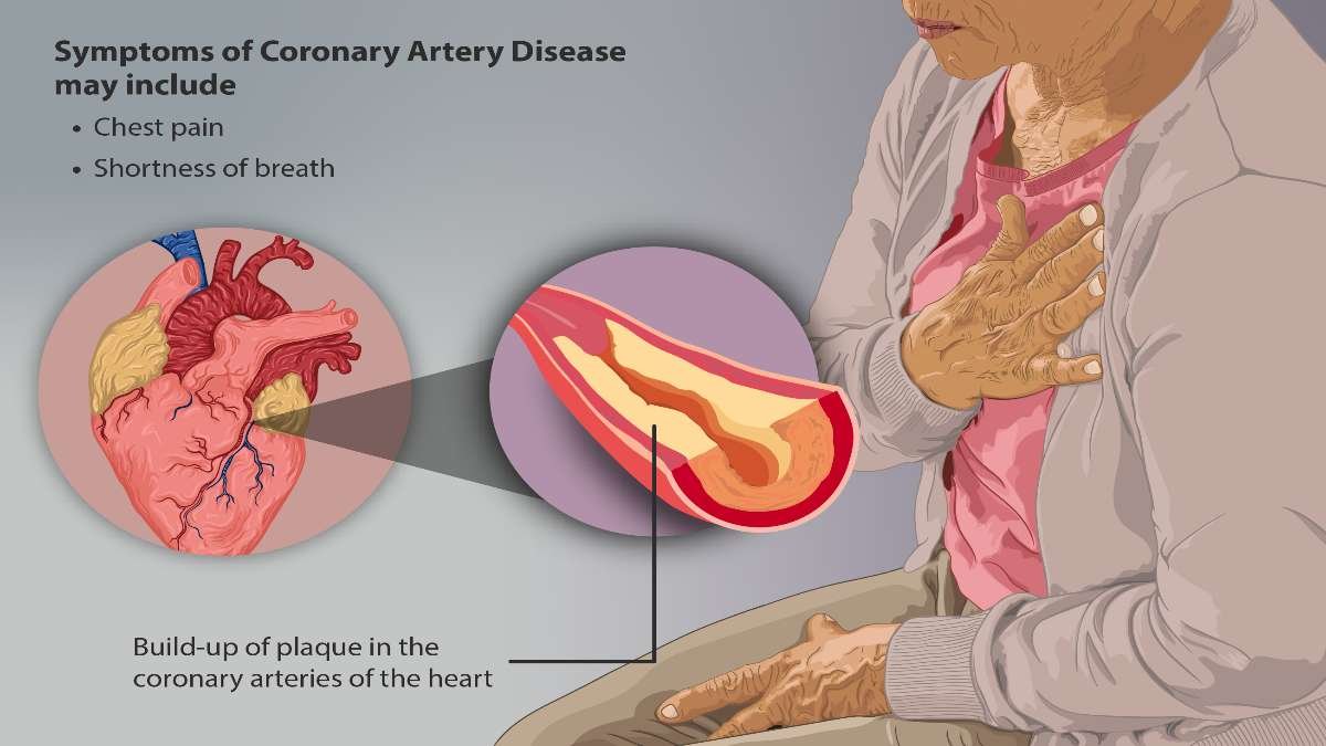 What is Coronary Artery Disease (CAD): Symptoms, Causes, Diagnosis, Treatment, and Prevention