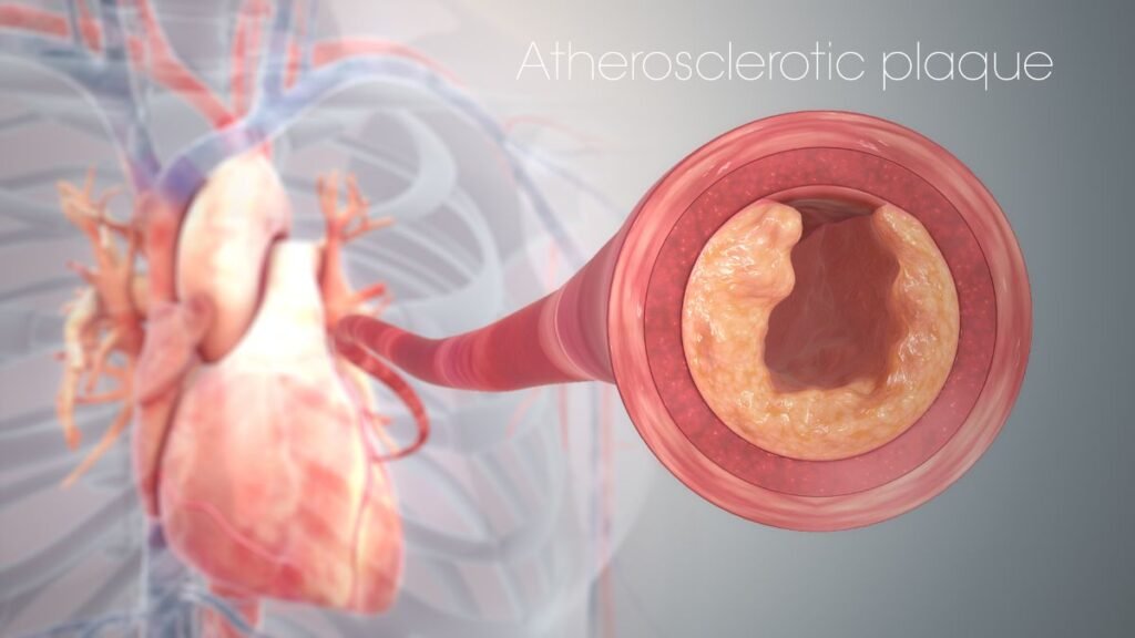 What is Atherosclerosis: Its Symptoms, Causes, Treatment, and Prevention