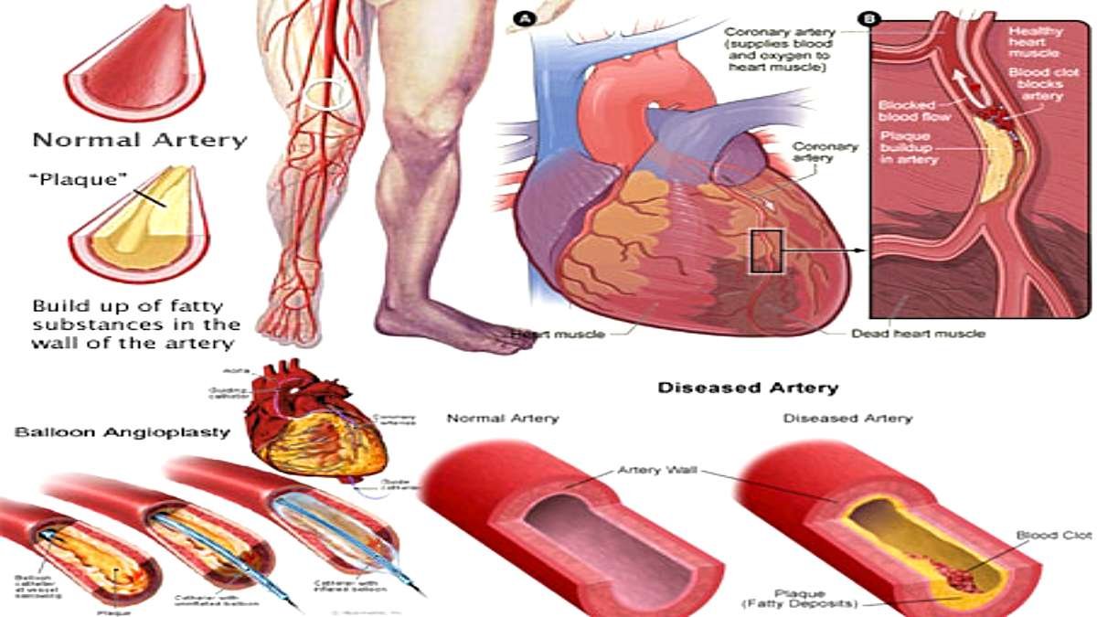 What is Peripheral Artery Disease (PAD): Its Symptoms, Causes, Treatment, & Prevention